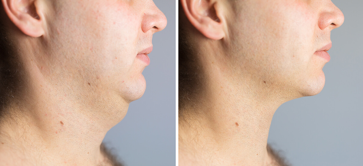 Chin and neck liposuction