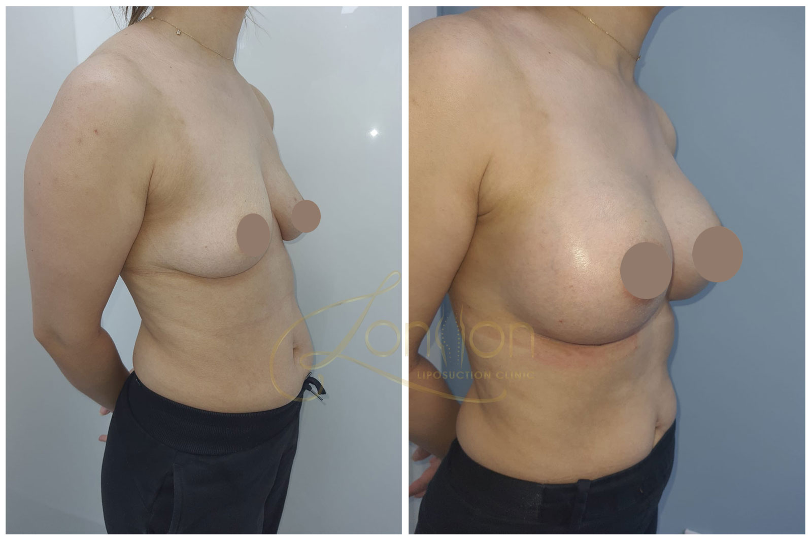 Breast augmentation side view before and after