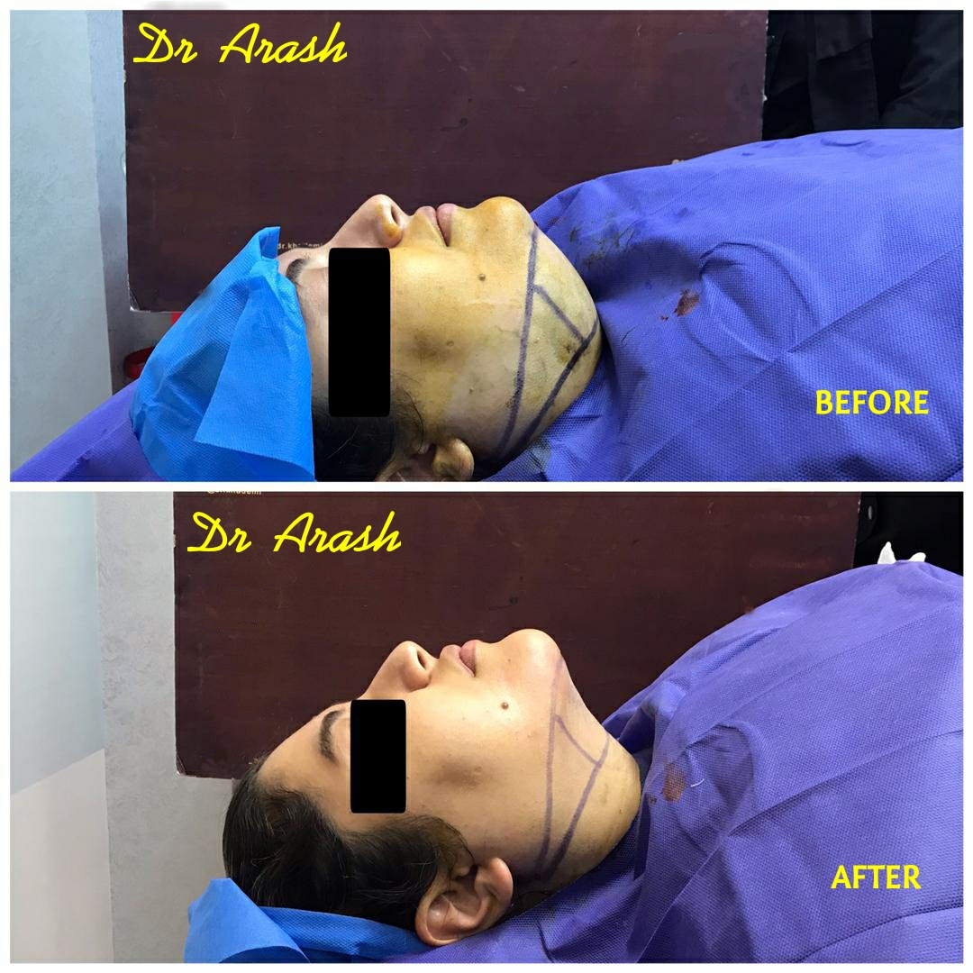 Chin and jawline liposuction before and after