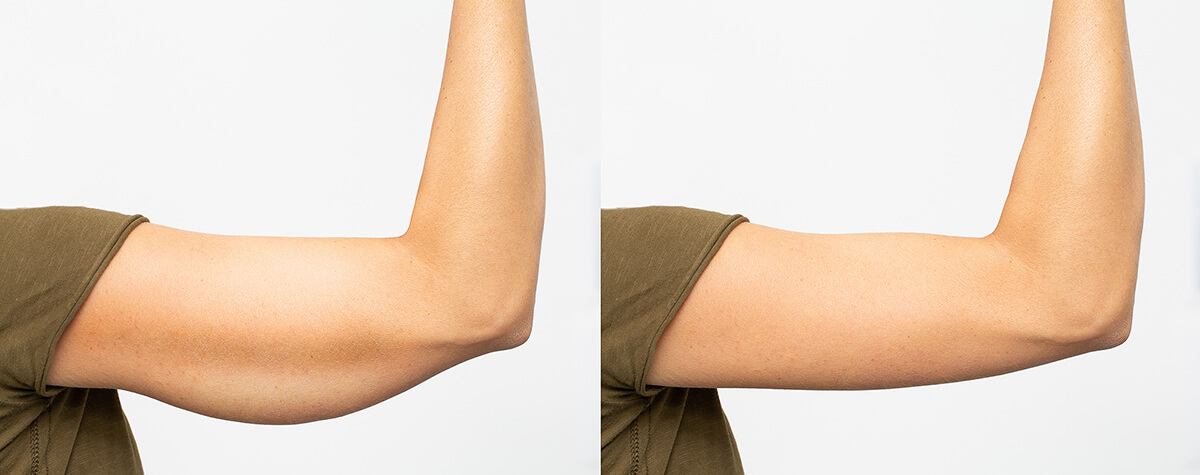 Arm liposuction before and after