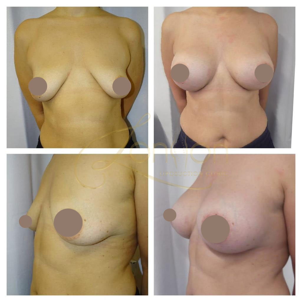Breast augmentation before and after comparison
