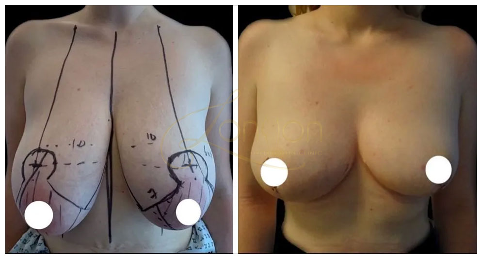 Breast lift before and after