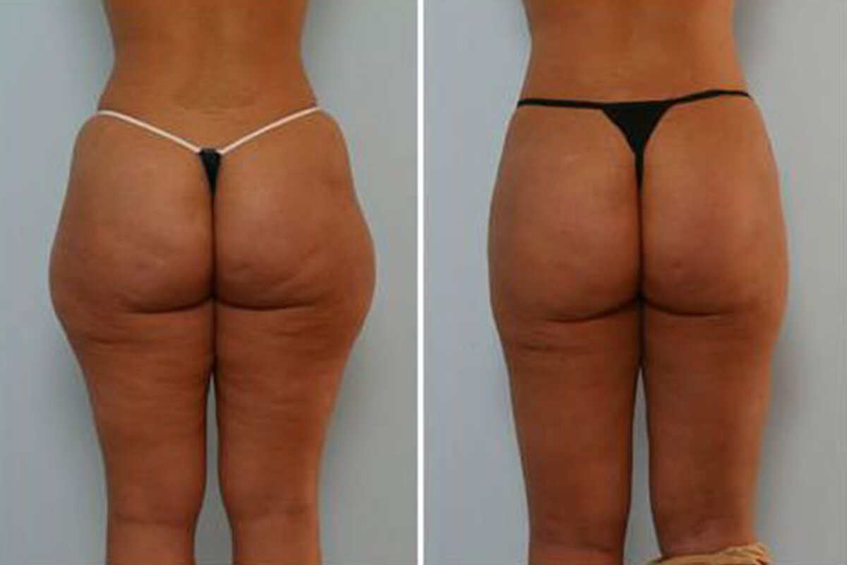 Abdomen and buttocks contouring