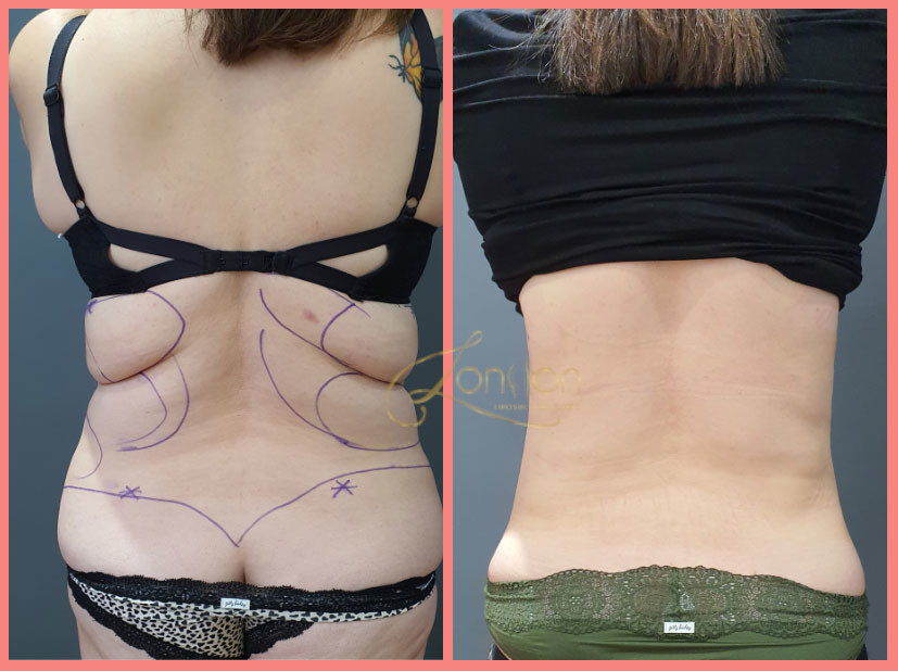 Flanks and sides liposuction