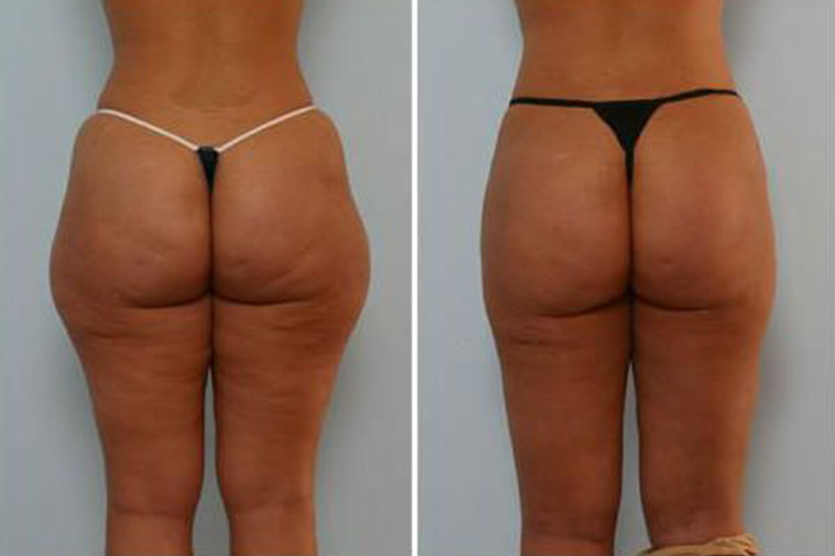Hip liposuction before and after