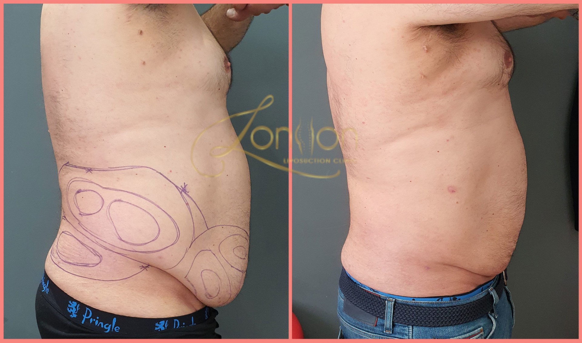 Male tummy liposuction before and after
