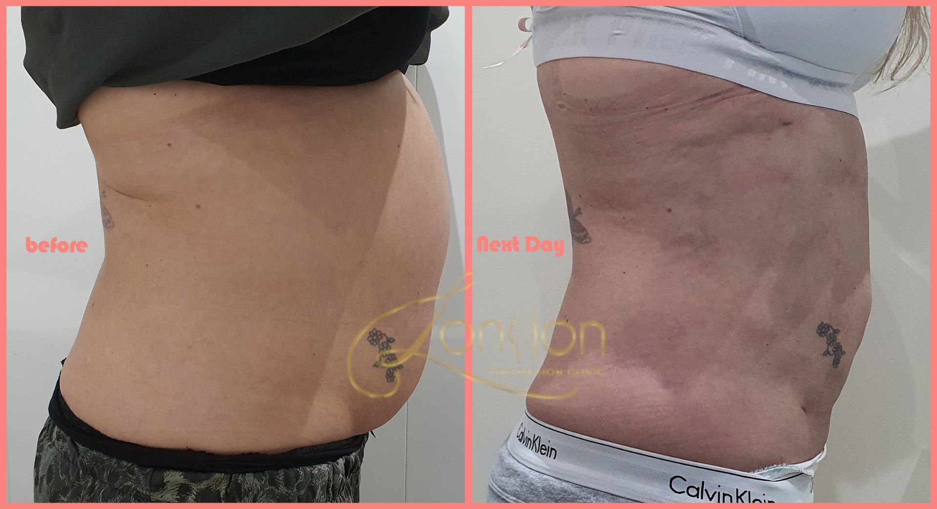Sides and abdomen liposuction before and next day