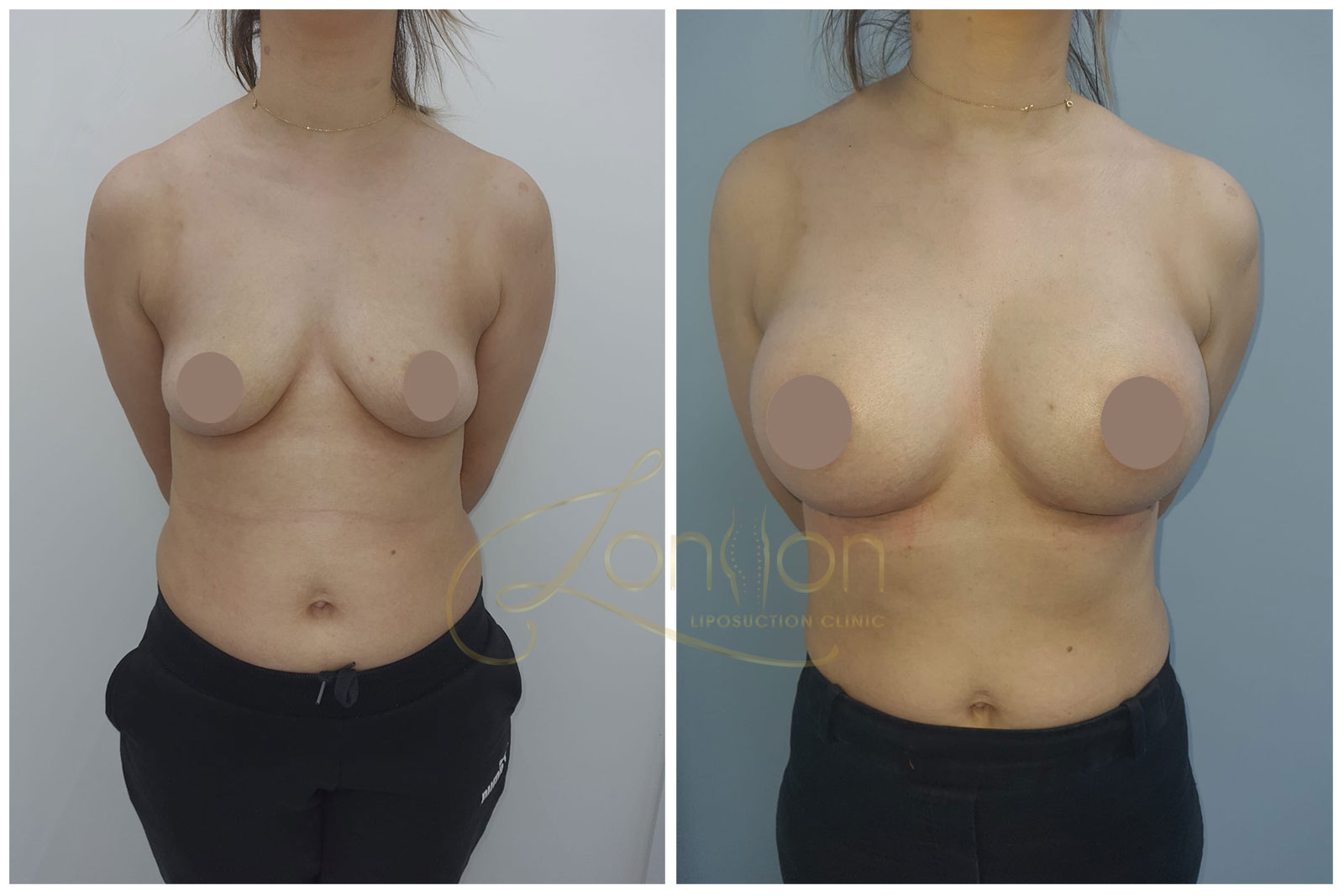 Breast augmentation front view before and after
